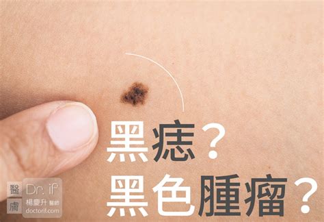 臉上的痣|不大驚小怪！如何辨別「黑痣」與「黑色腫瘤」？ 